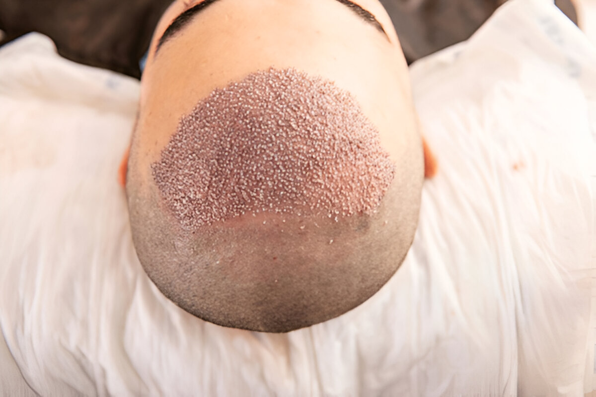 What Happens During a Hair Transplant Procedure?