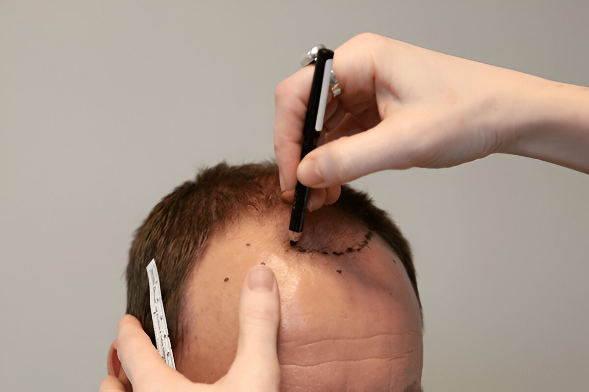 How Hair Transplants Help Restore Your Self-Esteem