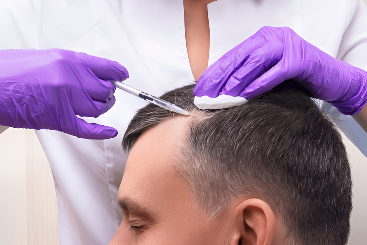 How Much Does a Hair Transplant Cost in London?