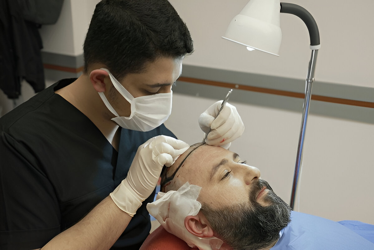 Hair Transplant