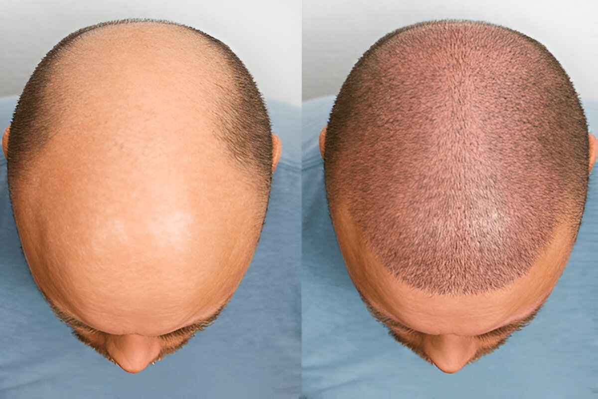 How to Find the Best Hair Transplant Surgeon in Harley Street