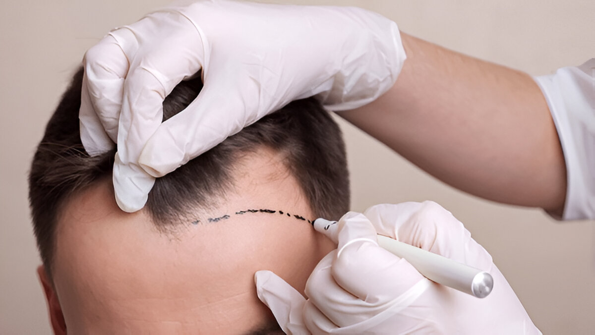 hair Transplant London