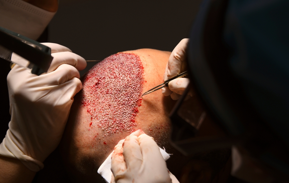 Hair Transplant Procedures: What’s the Difference Between FUE and FUT?
